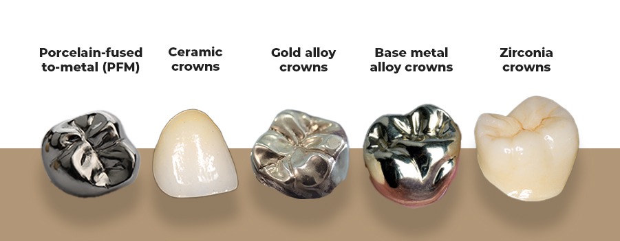 Types of Dental Crowns