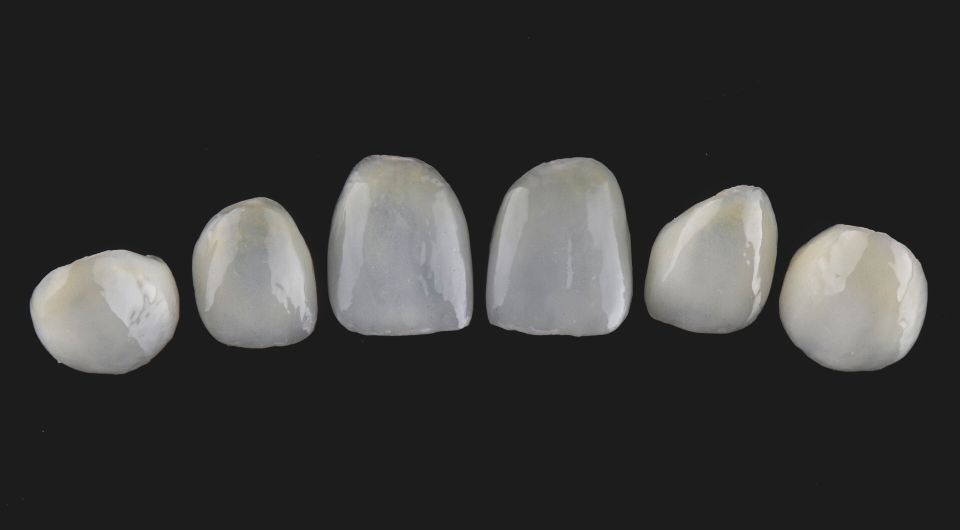 Types of dental veneers