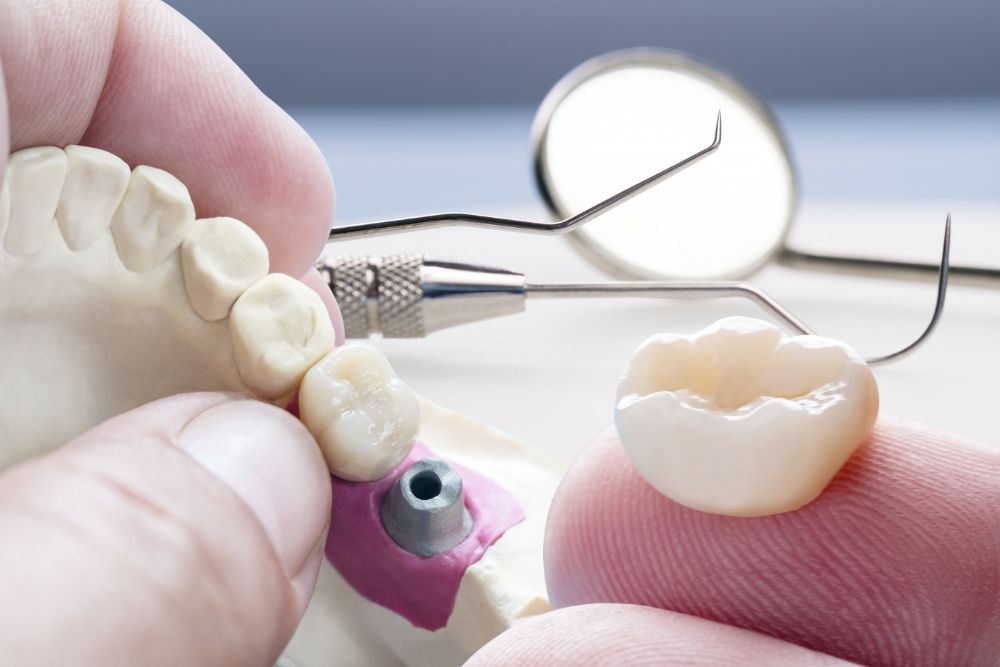 usage of Dental Crowns