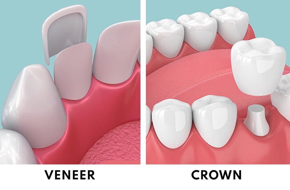 Veneers vs Crowns