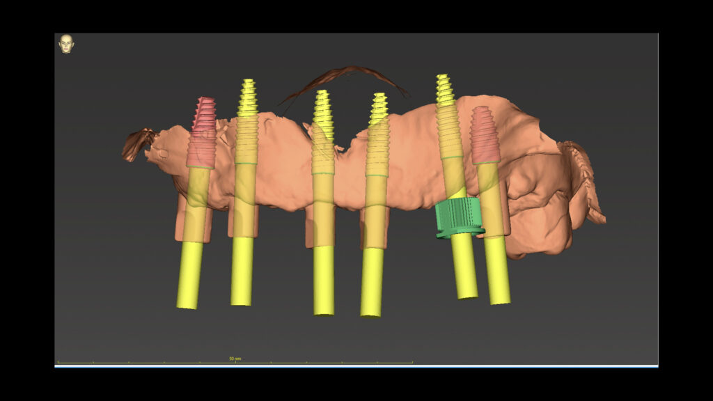 The All-on-6 Dental Implant Procedure