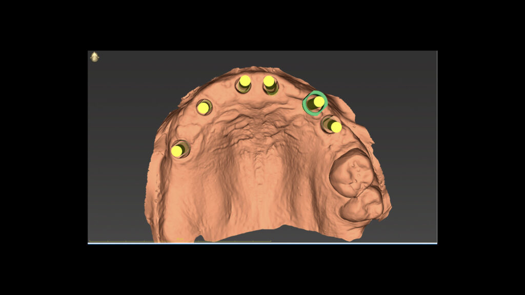 3D digital model for dental implant planning