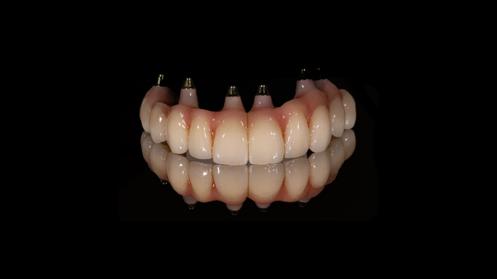 Full Mouth Dental Implants