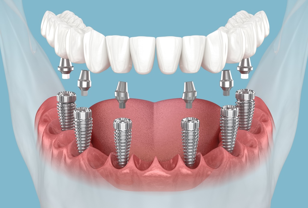 All-on-6 dental Implants