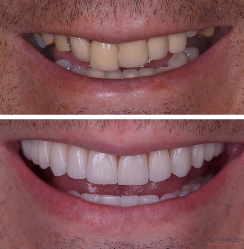 Full Mouth Dental Implants before and after