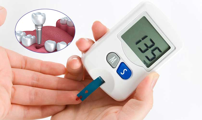 How Diabetes Impacts Dental Implant Success