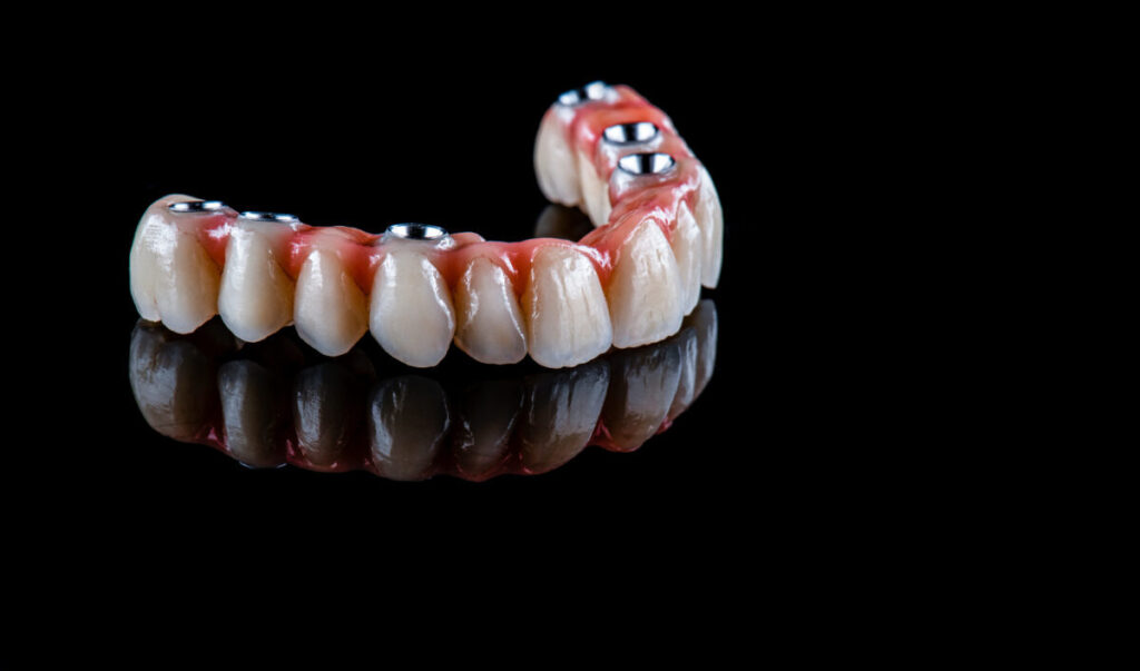 Benefits of Full-Mouth Dental Implants