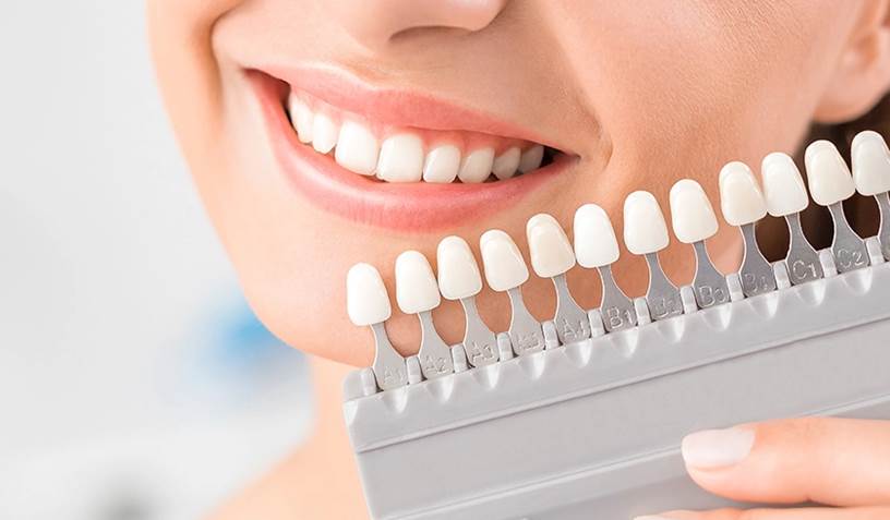 standard shade of dental veneers