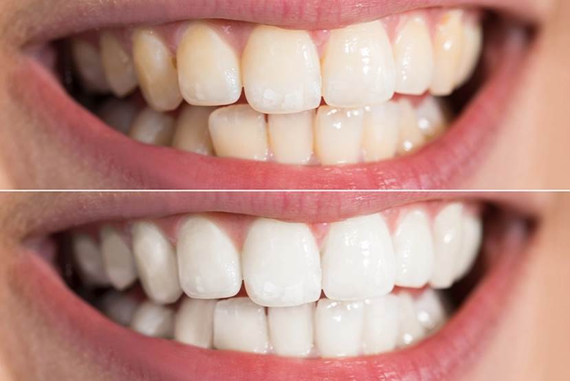 Dental Veneer before & after