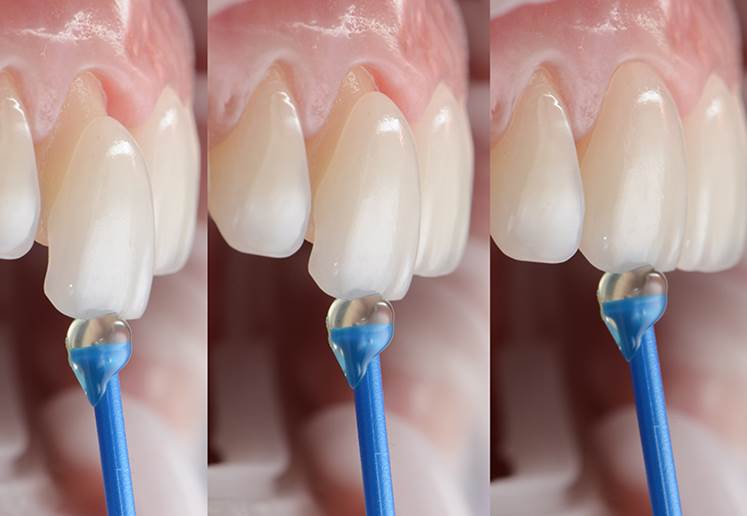 white dental veneers shade