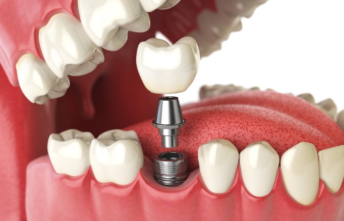 Benefits of Dental Implants for Diabetics