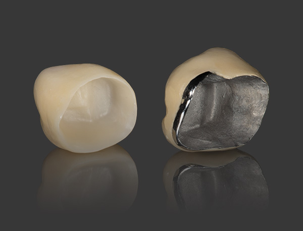 Porcelain-Fused-to-Metal (PFM) Crowns