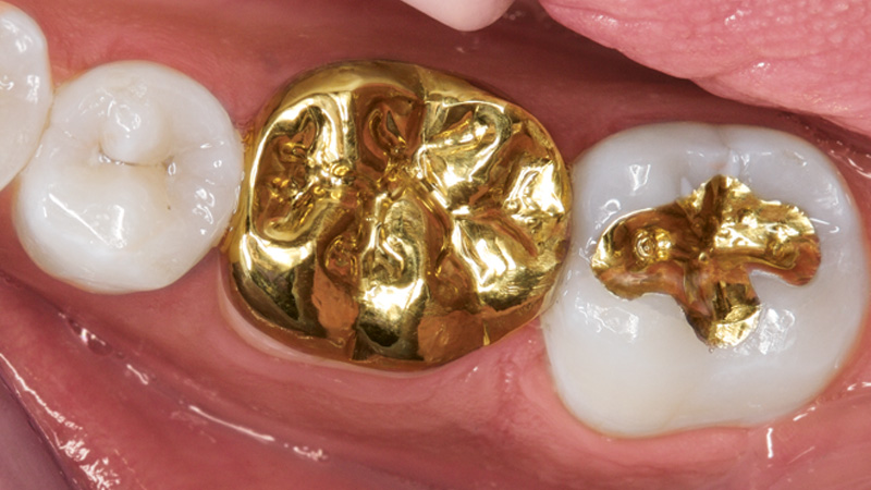 Gold Dental Crowns