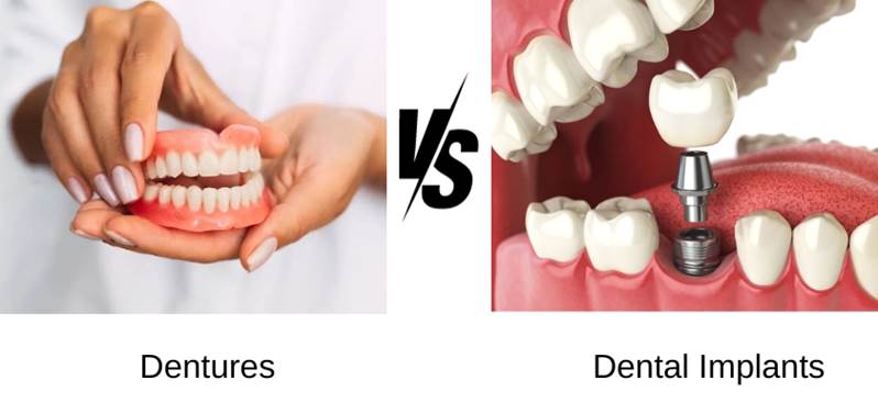 Dentures vs implants