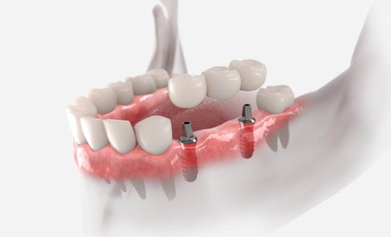 Do Implants Last Longer Than Dentures?