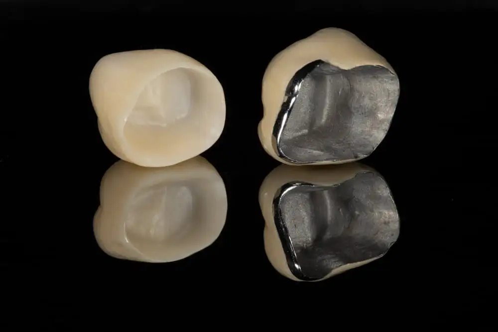 porcelain vs metal crowns