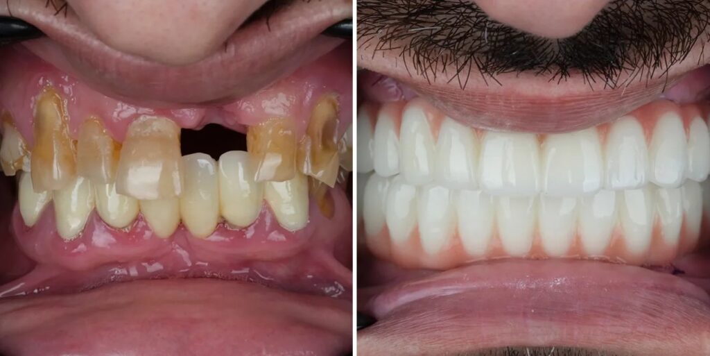DAmico Dental Care - Dental Implants in Wayland – Restore Your Smile Today - Ready for a full-mouth transformation? Discover our All-on-4 dental implants designed for natural, long-lasting results.