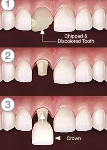 Limitations of Dental Crowns