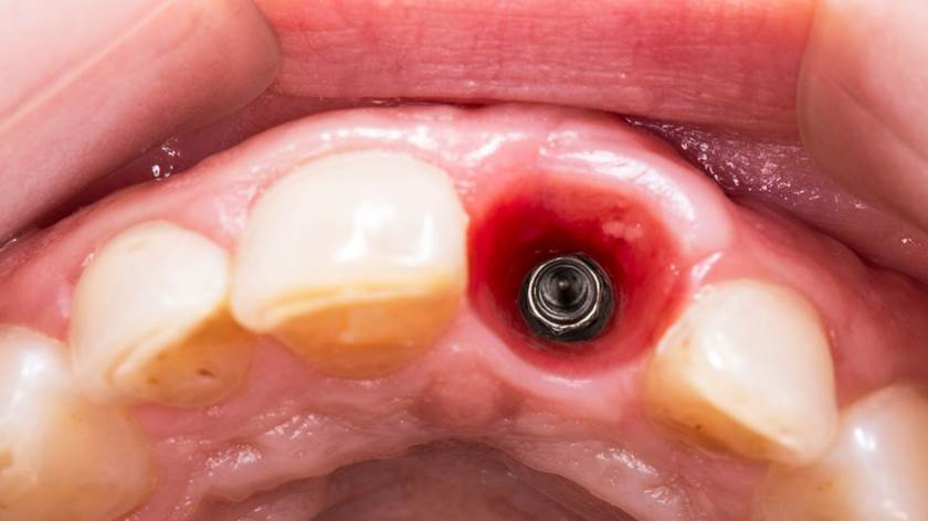 How Long Does the Dental Implant Healing Process Take?