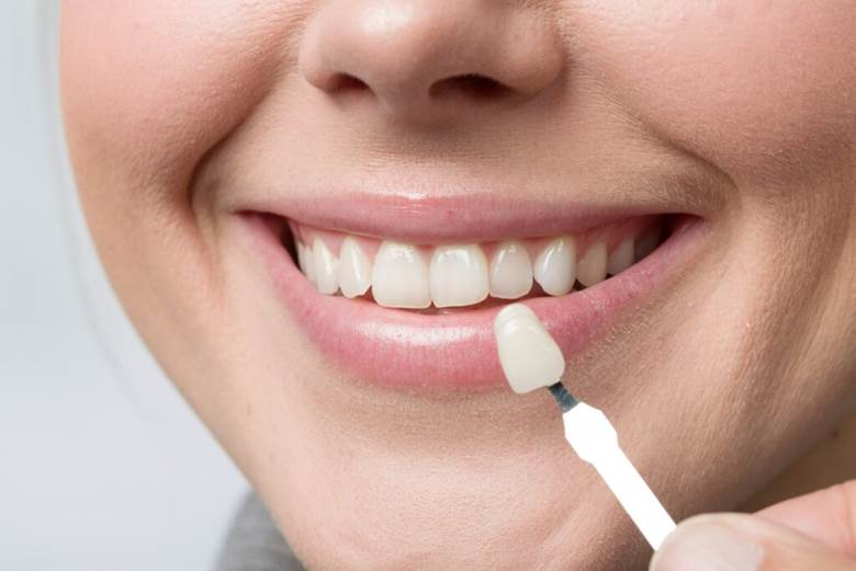 candidate of Veneers for Crooked Teeth