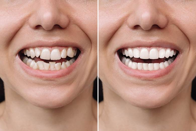 Veneers for crooked teeth