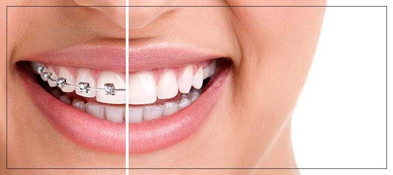 Benefits of Using Veneers for Crooked Teeth vs. Traditional Braces