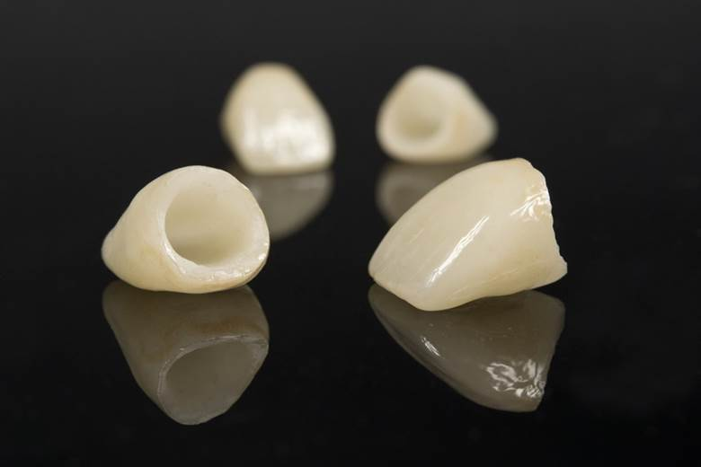 Dental crown longevity