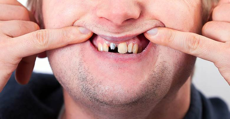 What Happens If Your Dental Crown Falls Out?