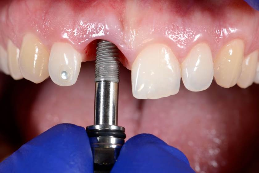 Common Challenges in the Early Dental Implant Healing Stages