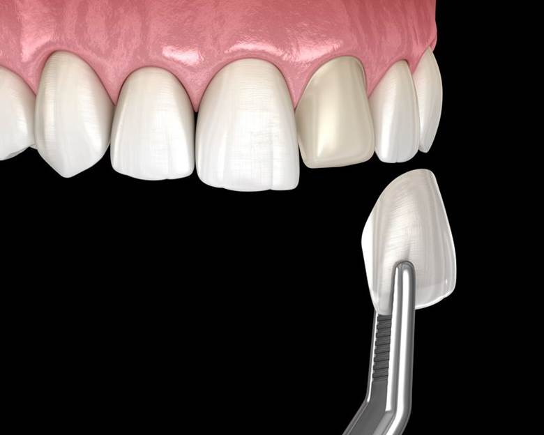 dental tool holding the veneer before it is placed onto the tooth