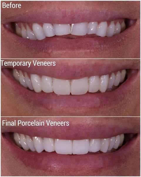 A comparison of before, temporary veneers, and final porcelain veneers