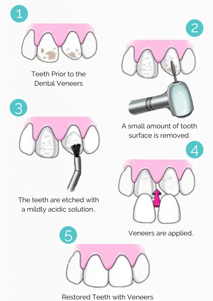 A step-by-step illustration of Porcelain Veneers Procedure