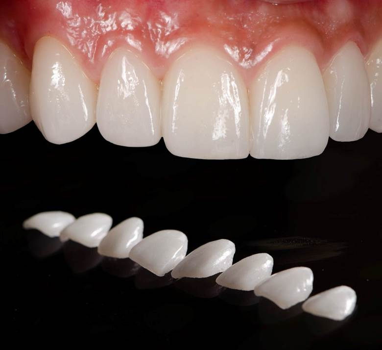Veneers and Lumineers