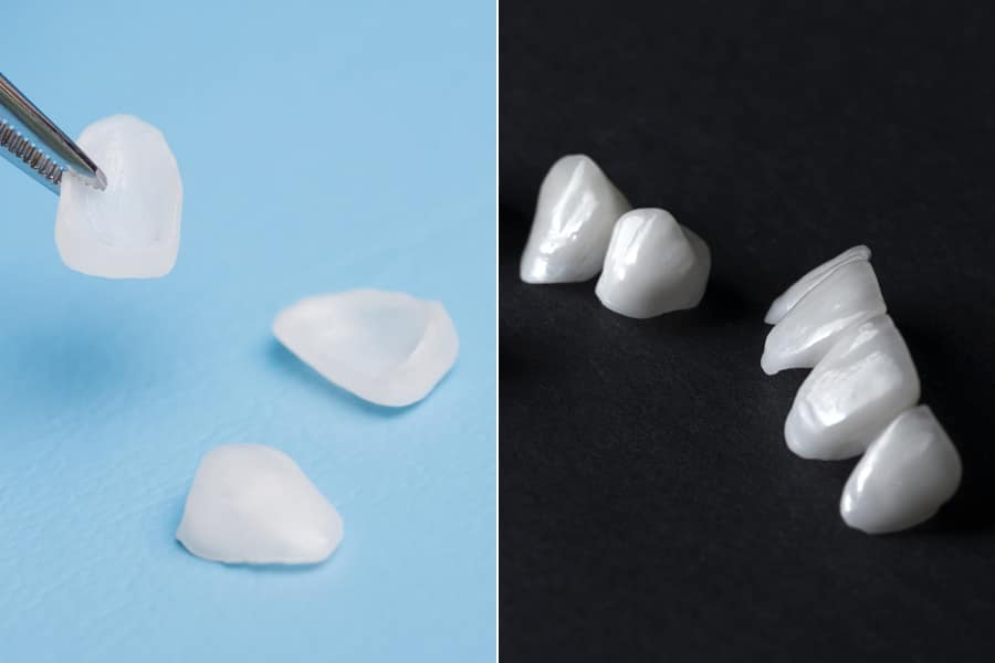 veneers and lumineers difference