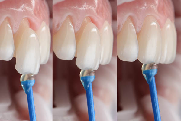 dental porcelain veneers procedure
