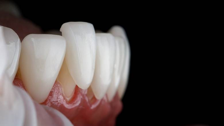 DAmico Dental Care - 7 Foods to Avoid with Porcelain Veneers for Long-Lasting Results - In this guide, we will fully explore the essential Foods to avoid with porcelain veneers, how you can enjoy your meals without constant worry, and what simple daily strategies exist to protect your investment and maximize its lifespan. By following these tips, you can enjoy a brilliant and healthy smile for years to come, a commitment we proudly support for everyone seeking porcelain Veneers in Wayland.