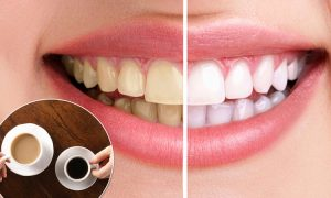 avoid dark-colored foods and drinks with veneers