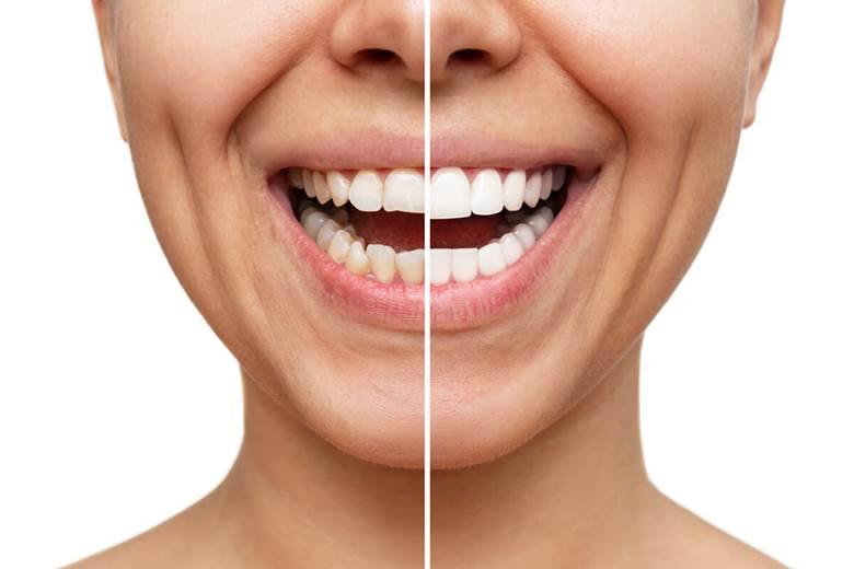 longevity of dental veneers