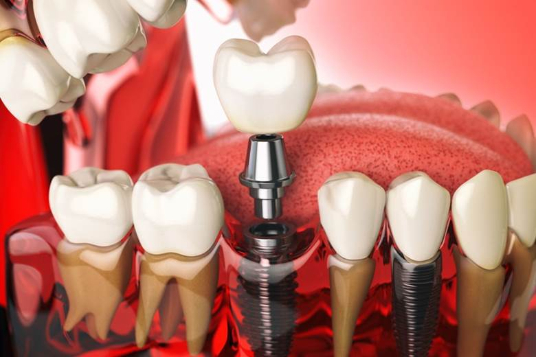 Process of Dental Implants