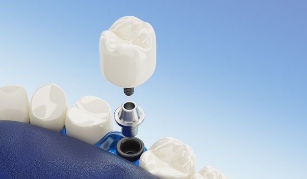 Dental implants longevity