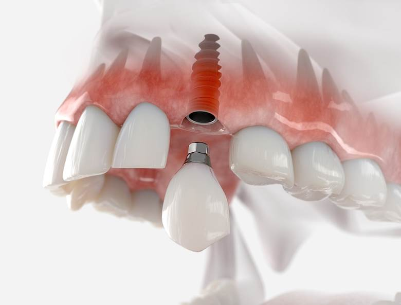 Benefits of Dental Implants