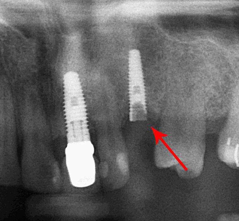 dental implant failure
