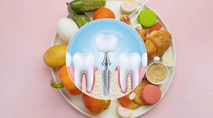 Foods to eat after a dental implant