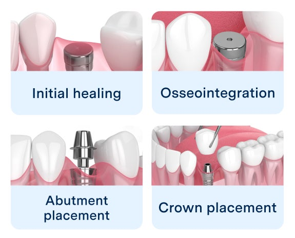 Dental Implant Healing Stages