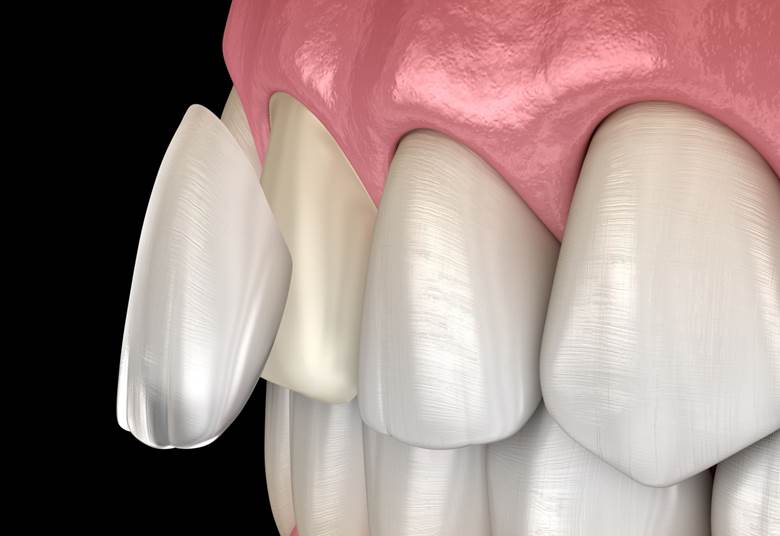 Is It Painful to Get Veneers for Crooked Teeth