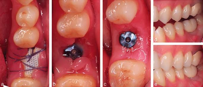 Dental Implant Healing phases