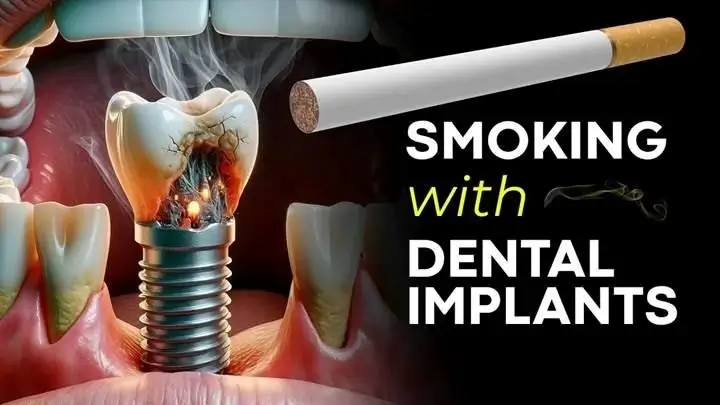 Smoking and dental implants