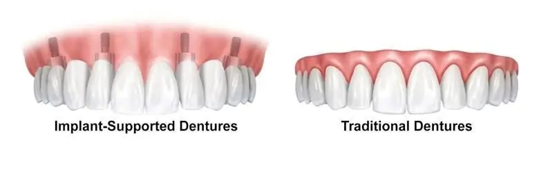 what is all on 4 dental implants