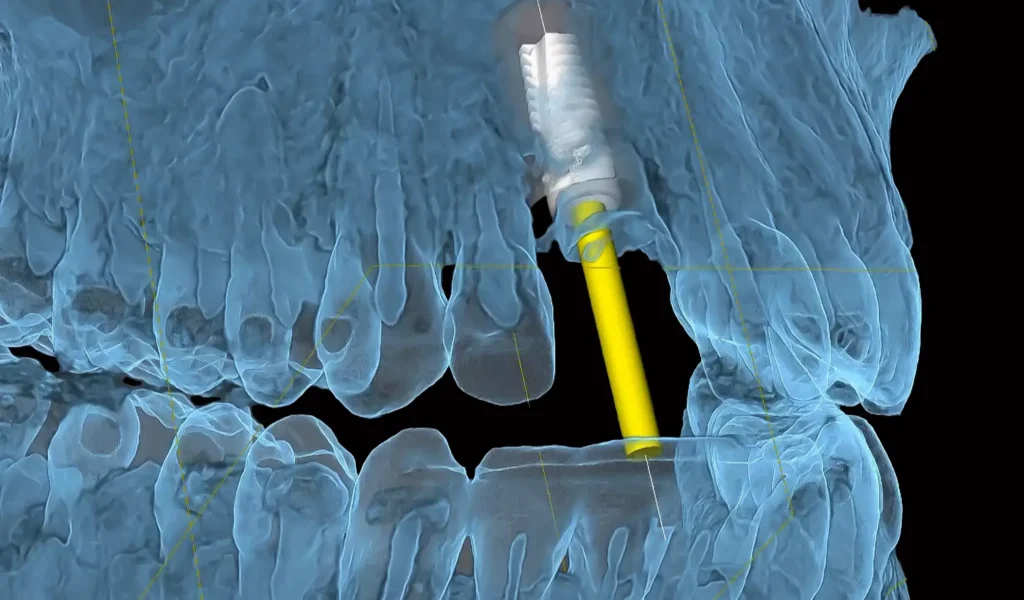 implants new technologies for better result