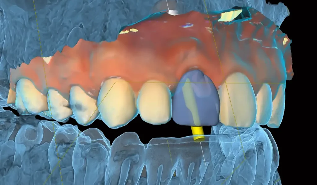 3d scan implants placement